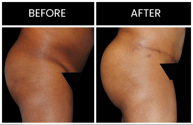 Can You Be Too Skinny For A BBL? - Atlanta Liposuction Specialty