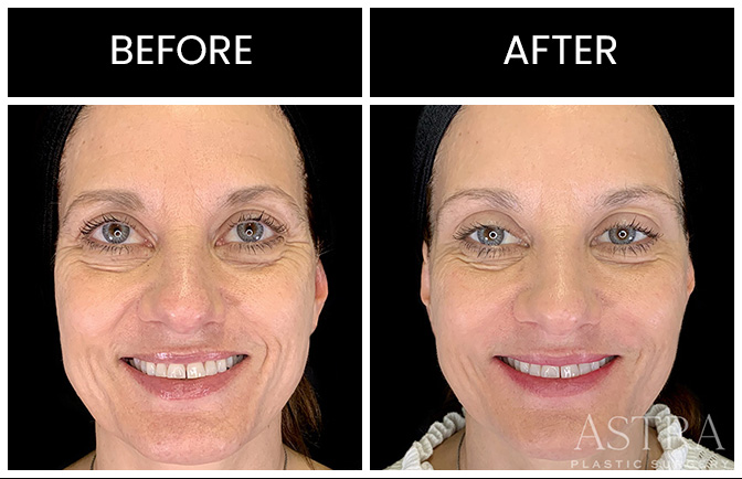 Atlanta Botox Results