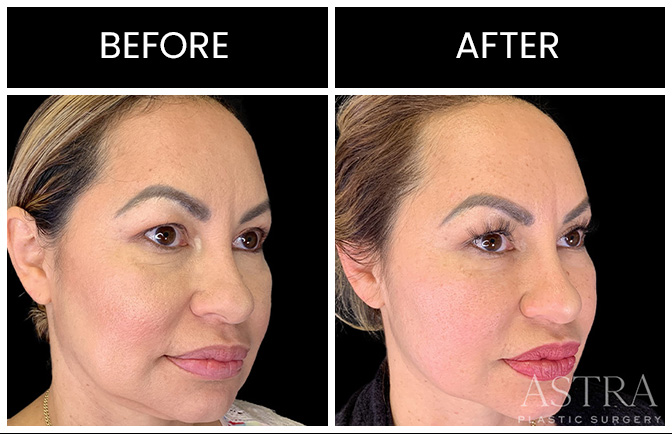 Atlanta Juvederm Results