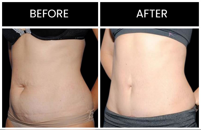 Tummy tuck skin tightening co2 laser therapy - Eve Clinics