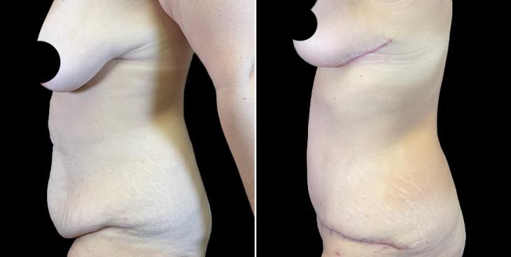 Before & After Tummy Tuck Cumming GA Side View