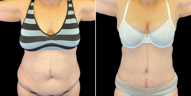 Patient E Body Builder - Pre -Operative Tummy Tuck Frontal Image