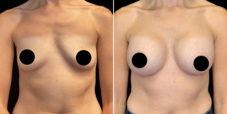 Cumming Georgia Breast Implants Before & After Front View