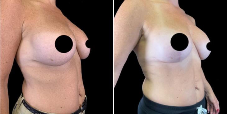 Before And After Breast Implant Exchange