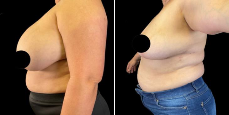 Breast Implant Removal & Lift Before & After