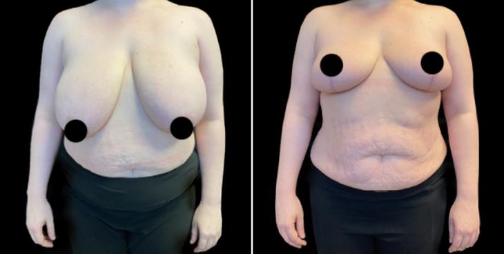 Before & After Breast Reduction