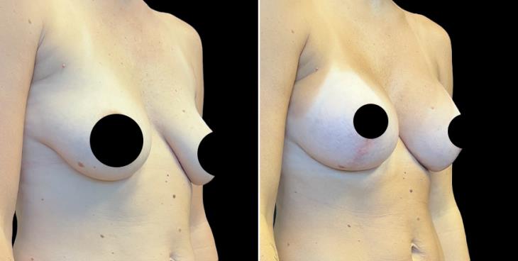 Breast Enhancement With Lift Results Atlanta
