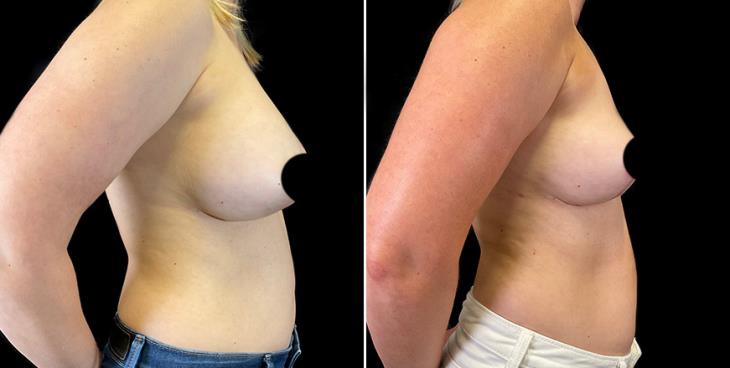 Side View Surgery To Lift Breasts Results