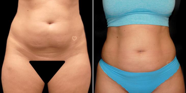 Lipo 360 Before & After