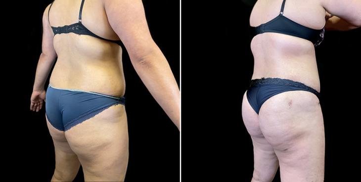 Atlanta Lipo 360 Before & After