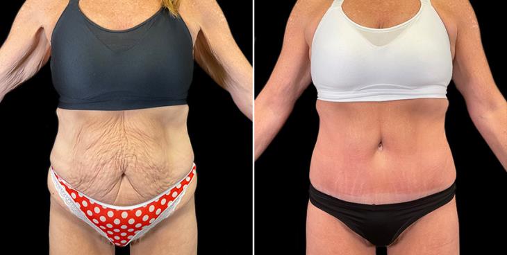 Liposuction Before After Atlanta Lipo Results