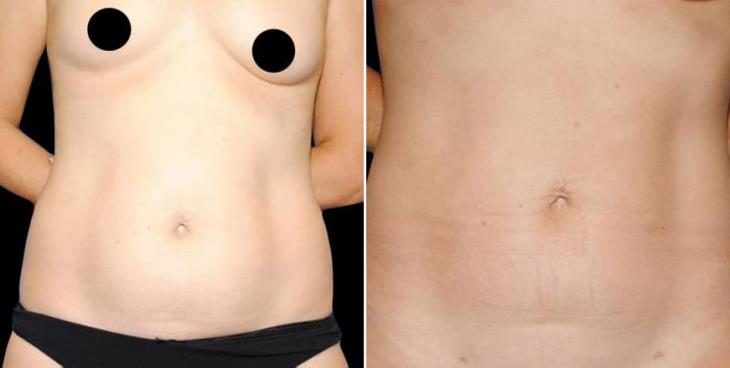 Liposuction Results Atlanta