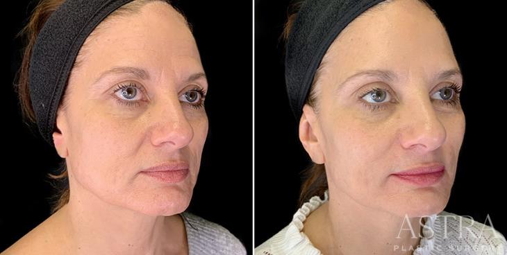 Cosmetic Fillers Before And After ¾ View