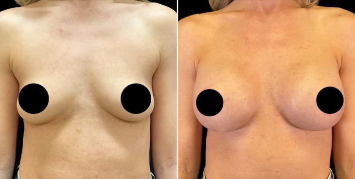 Breast Augmentation Alpharetta