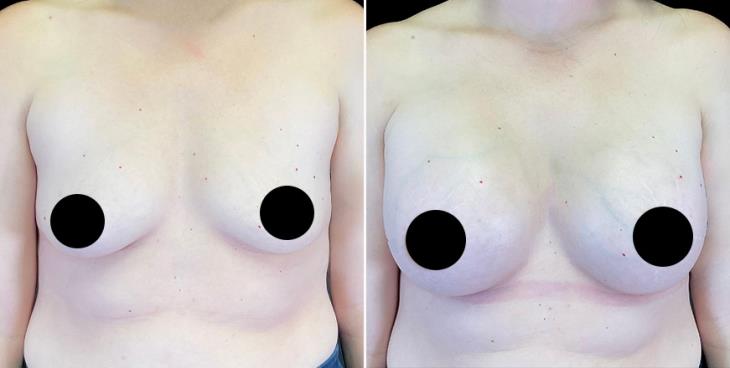 Before & After Breast Augmentation Alpharetta