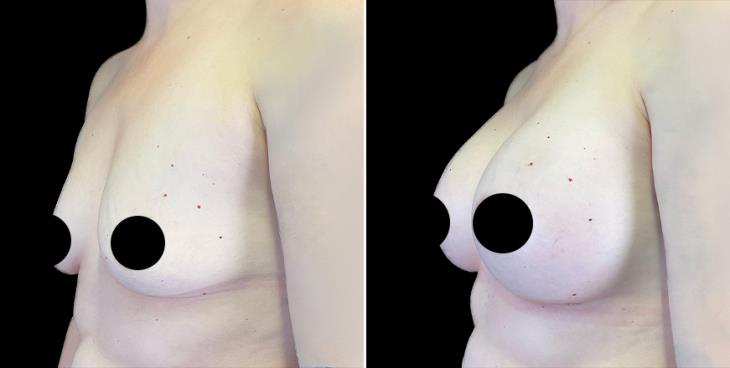 Before & After Breast Augmentation Alpharetta ¾ Left View