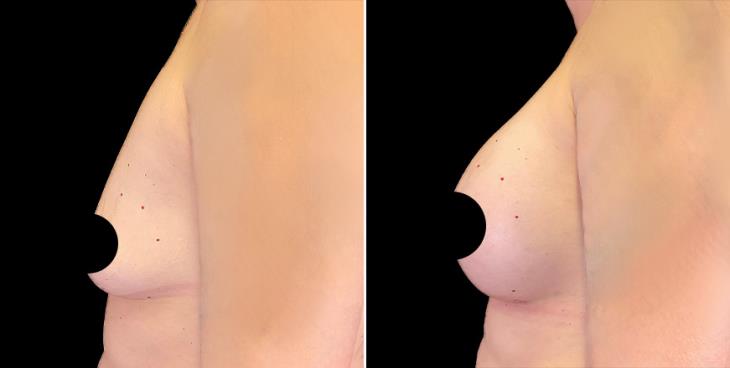 Before & After Breast Augmentation Alpharetta Left Side View