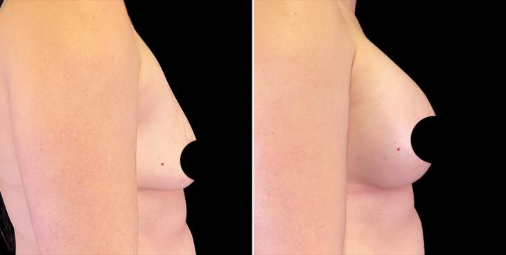 Before & After Breast Augmentation Alpharetta Right Side View