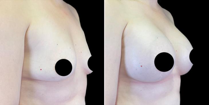 Before & After Breast Augmentation Alpharetta ¾ Right View