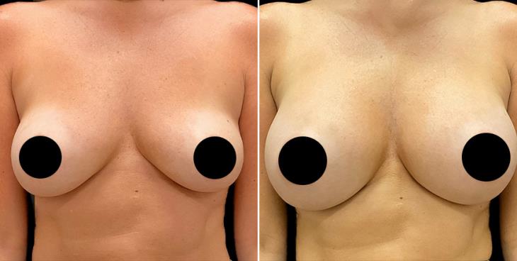 Before And After Breast Augmentation Alpharetta