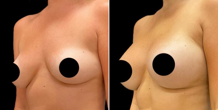 Before And After Breast Augmentation Alpharetta ¾ Left View