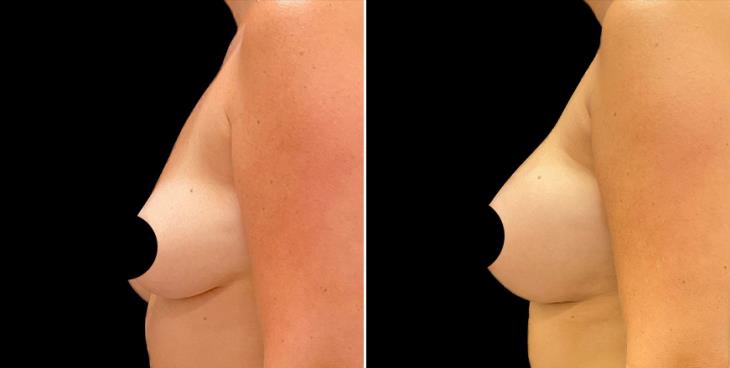 Before And After Breast Augmentation Alpharetta Left Side View