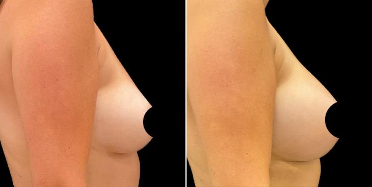 Before And After Breast Augmentation Alpharetta Right Side View