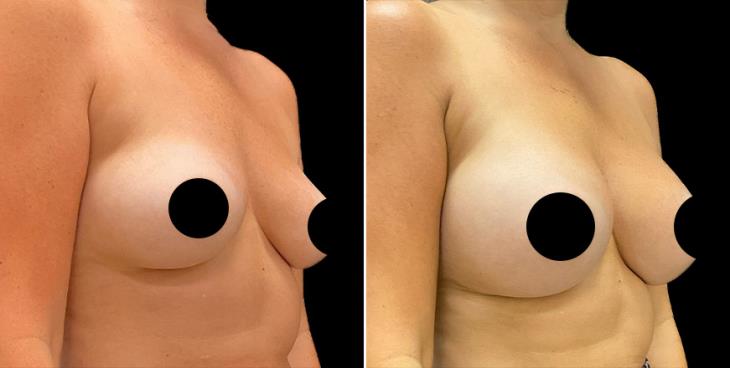 Before And After Breast Augmentation Alpharetta ¾ Right View