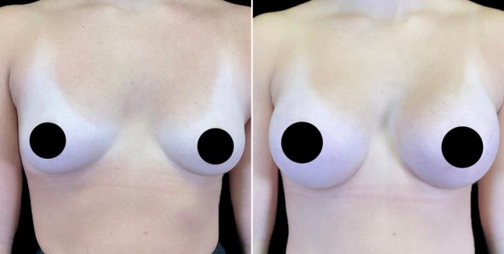 Alpharetta Breast Augmentation Results