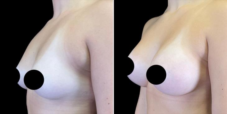 Alpharetta Breast Augmentation Results ¾ Left View