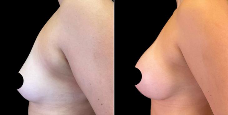 Alpharetta Breast Augmentation Results Left Side View