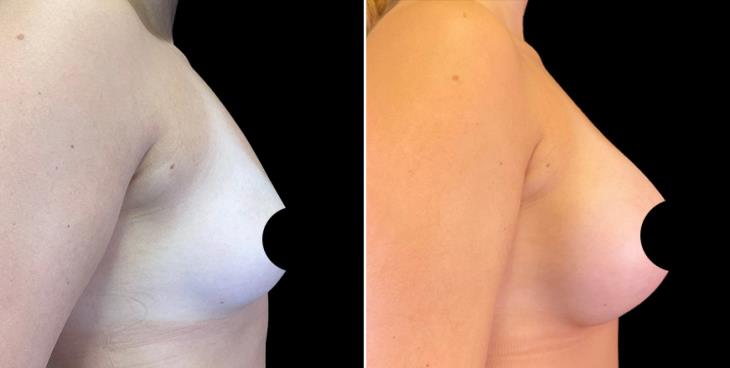 Alpharetta Breast Augmentation Results Right Side View