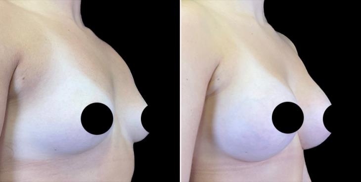 Alpharetta Breast Augmentation Results ¾ Right View