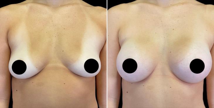 Breast Augmentation Results In Alpharetta