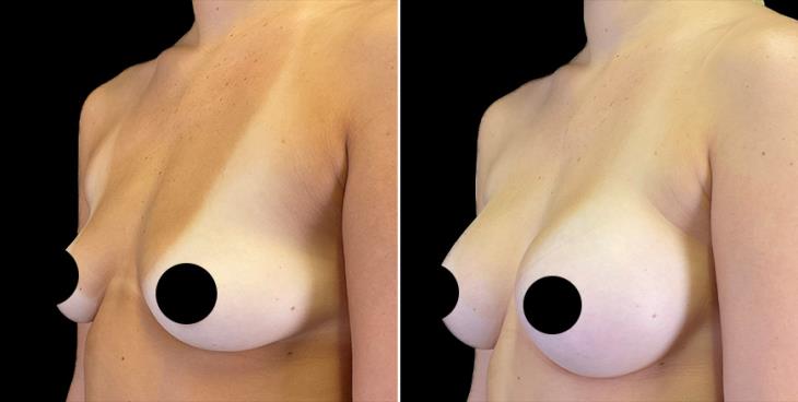 Breast Augmentation Results In Alpharetta ¾ Left View