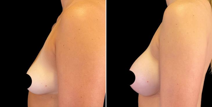 Breast Augmentation Results In Alpharetta Left Side View