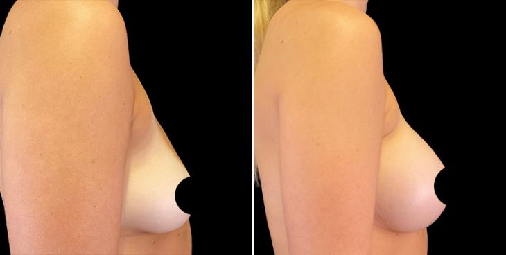 Breast Augmentation Results In Alpharetta Right Side View