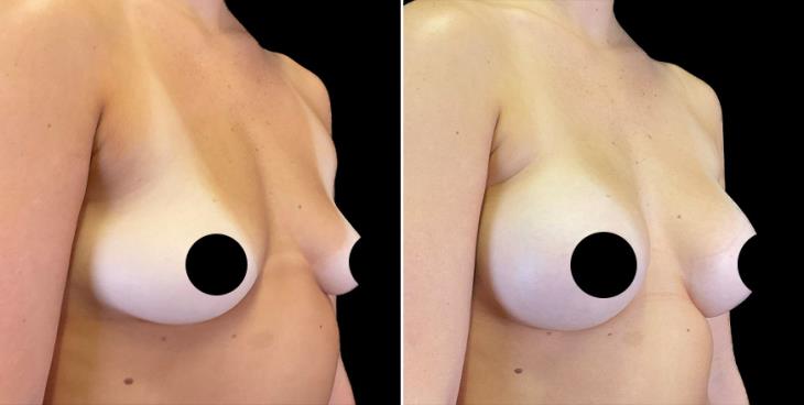 Breast Augmentation Results In Alpharetta ¾ Right View