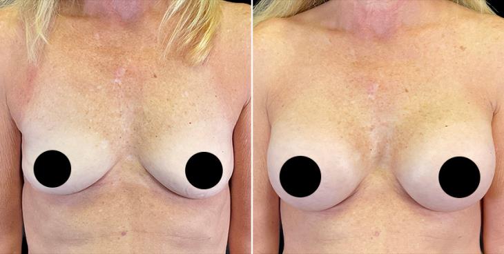 Breast Implant Results In Atlanta GA