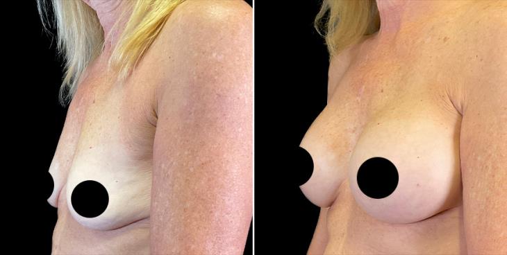 Breast Implant Results In Atlanta GA ¾ Left View