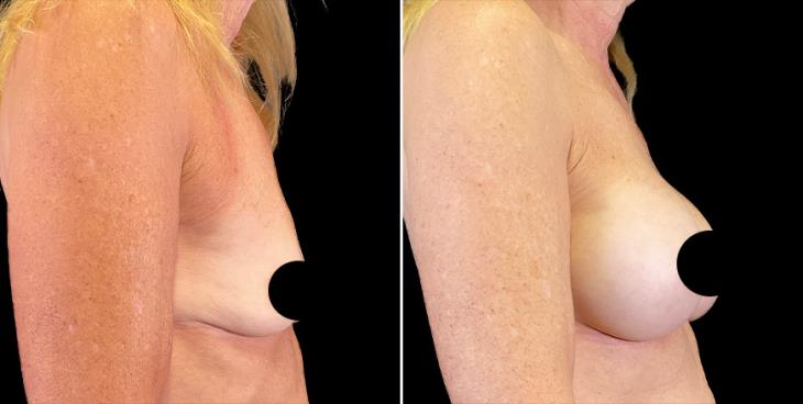 Breast Implant Results Alpharetta Right Side View