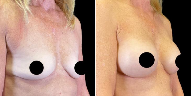 Breast Implant Results Alpharetta ¾ Right View