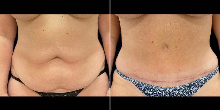 Alpharetta Tummy Tuck Results