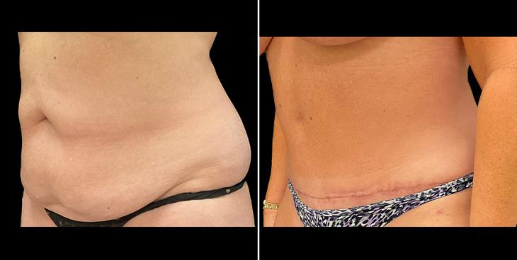 Alpharetta Tummy Tuck Results ¾ Left View