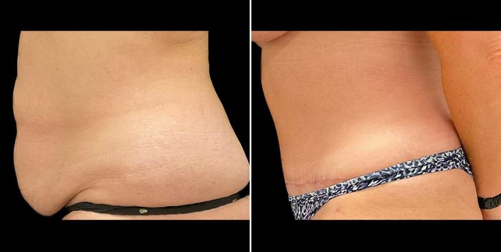 Alpharetta Tummy Tuck Results Left Side View