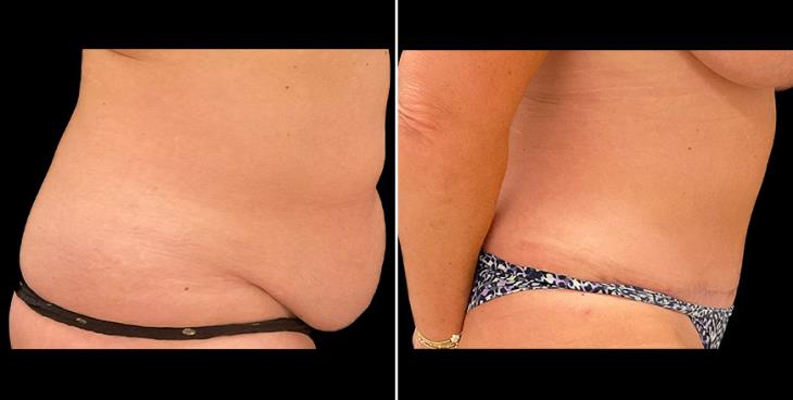 Alpharetta Tummy Tuck Results Right Side View