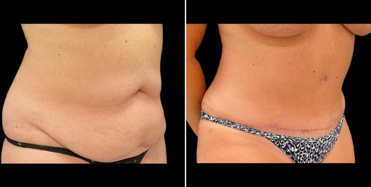 Alpharetta Tummy Tuck Results ¾ Right View