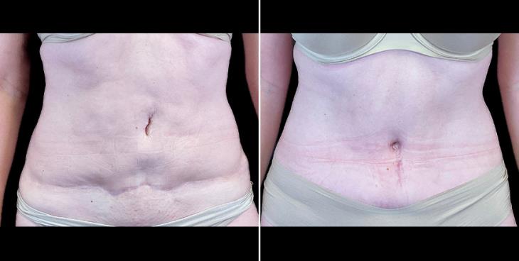 Tummy Tuck Results Alpharetta