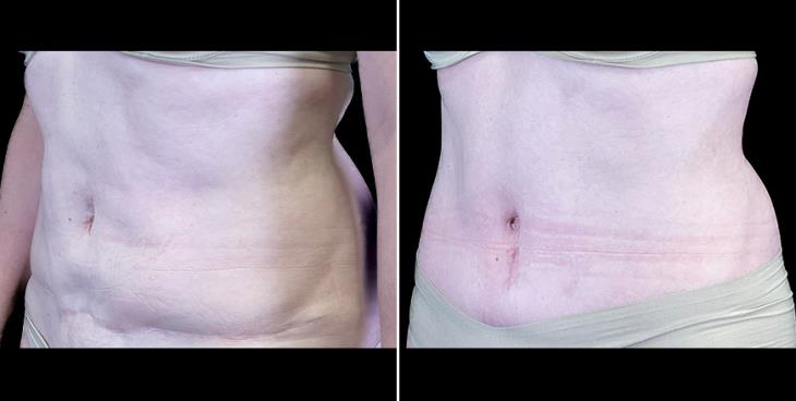 Tummy Tuck Results Alpharetta ¾ Left View