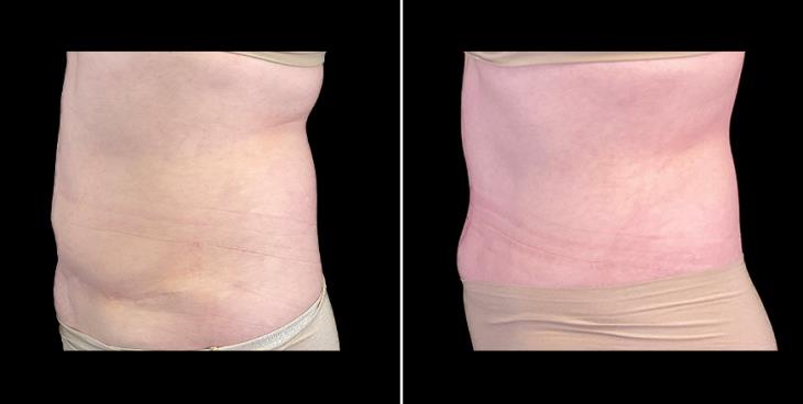 Tummy Tuck Results Alpharetta Left Side View